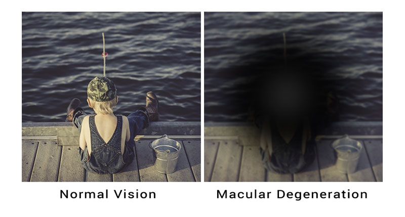 macular degeneration treatable adult eyecare local eye doctor near you small